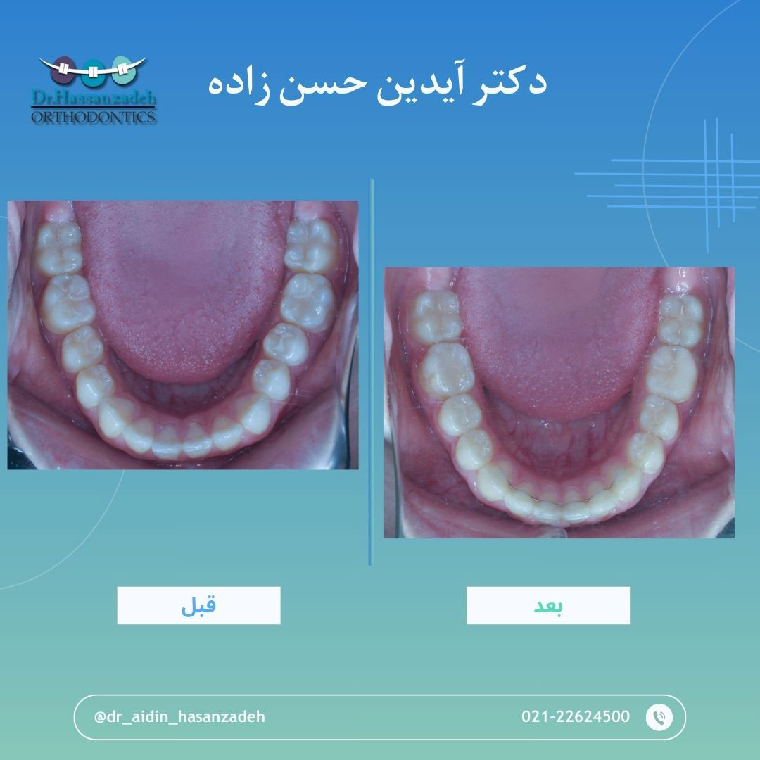 قبل و بعد از درمان اورتودنسی